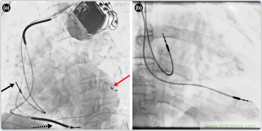 檢測並區分心髒起搏偽像